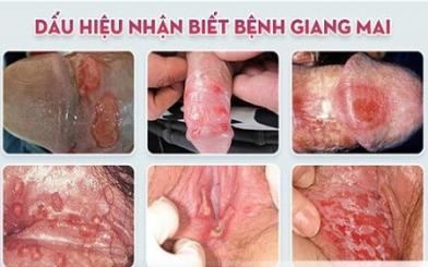 [ Tổng hợp ] Hình ảnh bệnh giang mai nguy hiểm theo từng giai đoạn