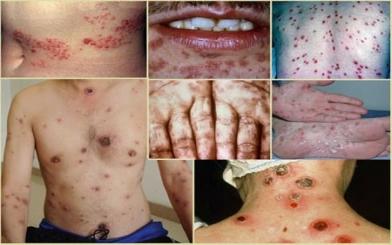 [ Review ] 10+ Triệu chứng giang mai phổ biến ở nam giới và nữ giới