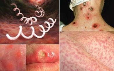 Giang mai lây qua đường nào ? 5 con đường chủ yếu của bệnh mà ít ai biết