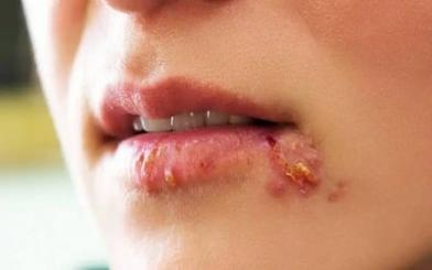 Hình ảnh bệnh giang mai ở miệng theo từng cấp đội ( chi tiết và đầy đủ )