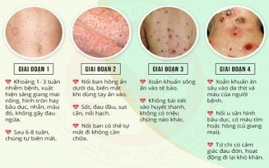 [GIẢI ĐÁP] Giang mai bao lâu thì phát bệnh? Địa chỉ khám bệnh uy tín