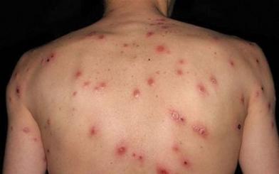 [ Giải Đáp ] Giang mai ở lưng có nguy hiểm không và chữa như nào ?
