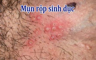 Mụn rộp sinh dục nữ : Nguyên nhân, triệu chứng và cách điều trị hiệu quả
