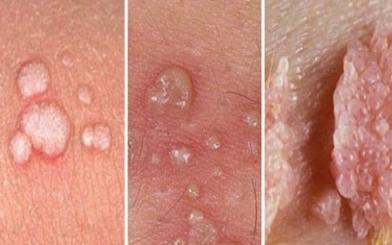 [ Tìm Hiểu ] Mụn rộp sinh dục giai đoạn đầu có nguy hiểm không và chữa như nào ?