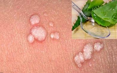 [ Review ] 10+ Cách chữa mụn rộp sinh dục tại nhà  hiệu quả và an toàn hiện nay