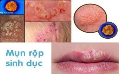 [ Giải Đáp ] Mụn rộp sinh dục có nguy hiểm không và 3 cách khắc phục hiệu quả
