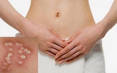 [ Giải Đáp ] Tái phát mụn rộp sinh dục nguyên nhân do đâu và chữa như nào ?