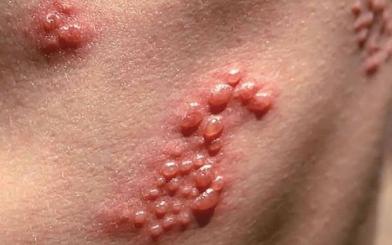 [ Giải Đáp ] Mụn rộp sinh dục có sao không và chữa như nào hiệu quả ?