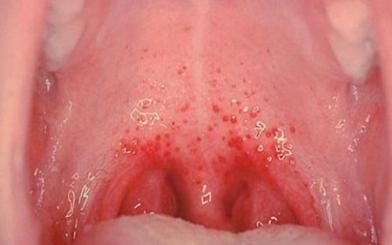 Mụn rộp sinh dục ở họng : Nguyên nhân, triệu chứng và 2 cách điều trị hiệu quả
