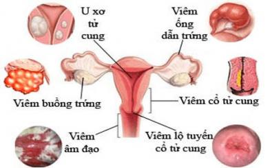 Viêm phụ khoa nặng : Nguyên nhân, triệu chứng và cách điều trị hiệu quả 2023