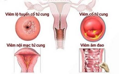 [ Mách Bạn ] 10+ Cách chữa viêm phụ khoa nặng hiệu quả cho người bệnh