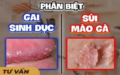 Gai sinh dục khác sùi mào gà như thế nào ?