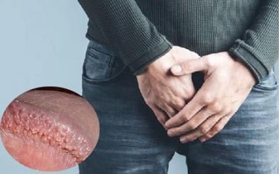 Gai sinh dục thường mọc ở đâu và chữa như nào hiệu quả