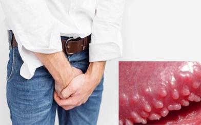Gai sinh dục có tự khỏi không và chữa như nào hiệu quả ?