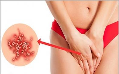 Gai sinh dục có ngứa không và chữa như thế nào ?