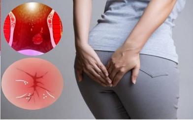 Trĩ nội xuất huyết là gì và có nguy hiểm không ?