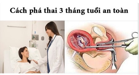Liệu 3 tháng có phá thai được không ?