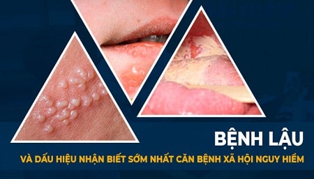 Khi mắc bệnh lậu người bệnh cần phải lưu ý những vấn đề gì?