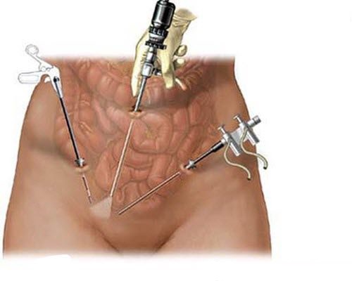 Bác sĩ mổ u nang buồng trứng giỏi