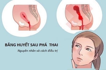 Nguyên nhân nào gây băng huyết sau phá thai ?