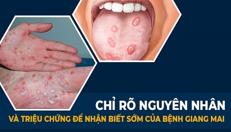 Nguyên nhân chủ yếu gây bệnh giang mai