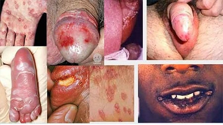 Biến chứng khi không điều trị bệnh giang mai kịp thời