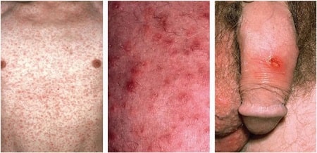 Giải đáp bệnh giang mai có chữa được không ?