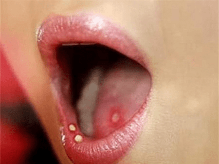 Biểu hiện cho thấy bệnh giang mai lây truyền qua đường nước bọt