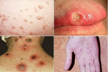 Biến chứng của bệnh lý giang mai 