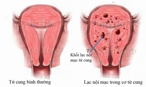 Lạc nội mạc tử cung