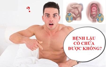 Bị lậu có thể chữa khỏi không ?