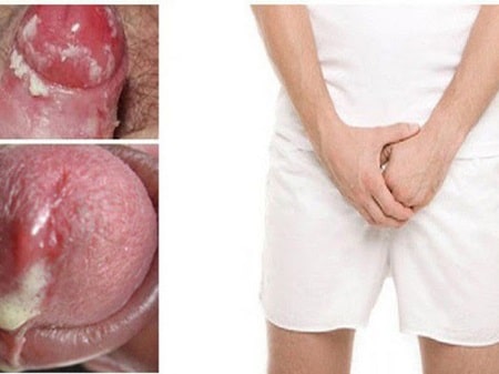 Những biến chứng khi không điều trị bệnh lậu?