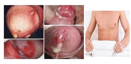 Biểu hiện bệnh lậu ở nam giới