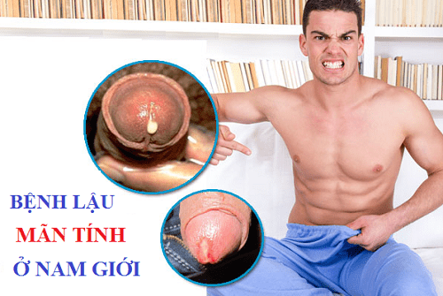 Bệnh lậu mãn tính