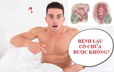 Nam giới bị bệnh lậu có chữa được không?