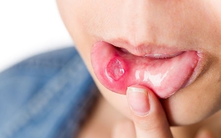 Bệnh lậu ở miệng có nguy hiểm không?