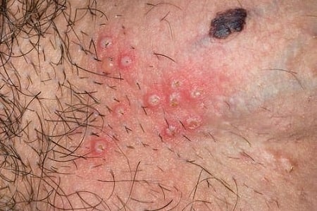 Bệnh mụn rộp sinh dục có gây nguy hiểm tới sức khỏe không ?