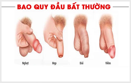 Bệnh nam khoa vùng kín nam giới thường gặp