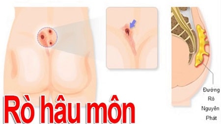 Bệnh rò hậu môn nguy hiểm như thế nào?