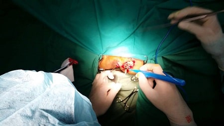 Kinh nghiệm chữa rò hậu môn hiệu quả