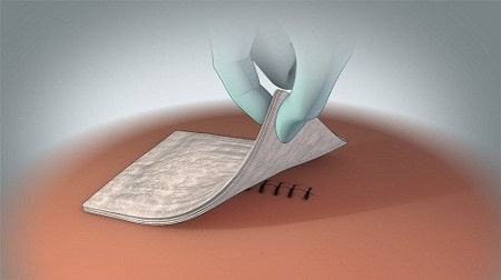 Hướng dẫn cách chăm sóc sau điều trị rò hậu môn