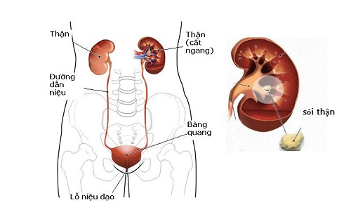 Bệnh sỏi đường tiết niệu