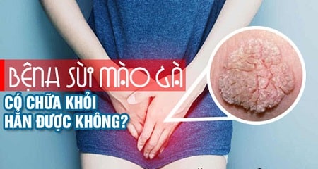 Khi mắc sùi mào gà có chữa được không ?