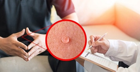 Các phòng ngừa bệnh sùi mào gà lây lan