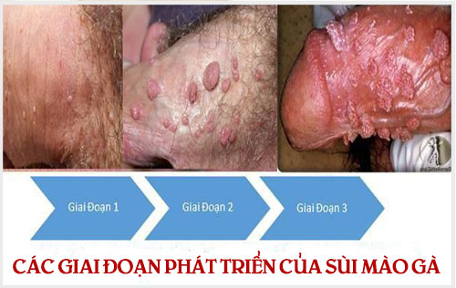 Các giai đoạn phát triển của bệnh sùi mào gà