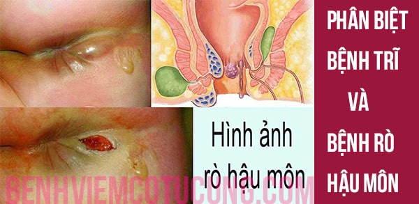   Dấu hiệu nhận biết và rò hậu môn