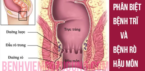 Khái niệm bệnh trĩ và rò hậu môn
