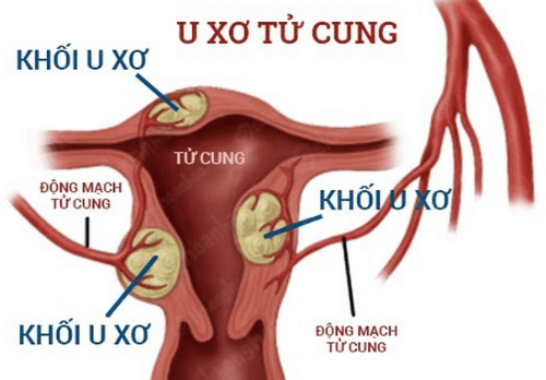 Bệnh u xơ tử cung là gì?