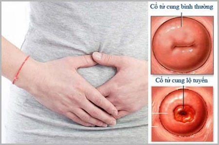 Viêm lộ tuyến cổ tử cung độ 4 có nguy hiểm không? 