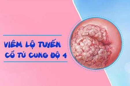Viêm lộ tuyến cổ tử cung độ 4 là gì?